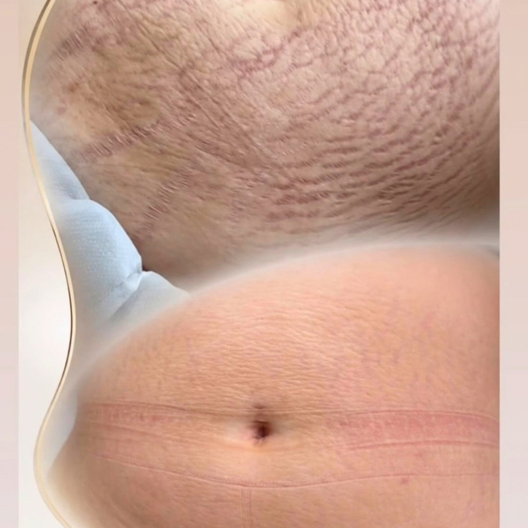 Cameo Clinic - Stretch Mark & Scar Treatment