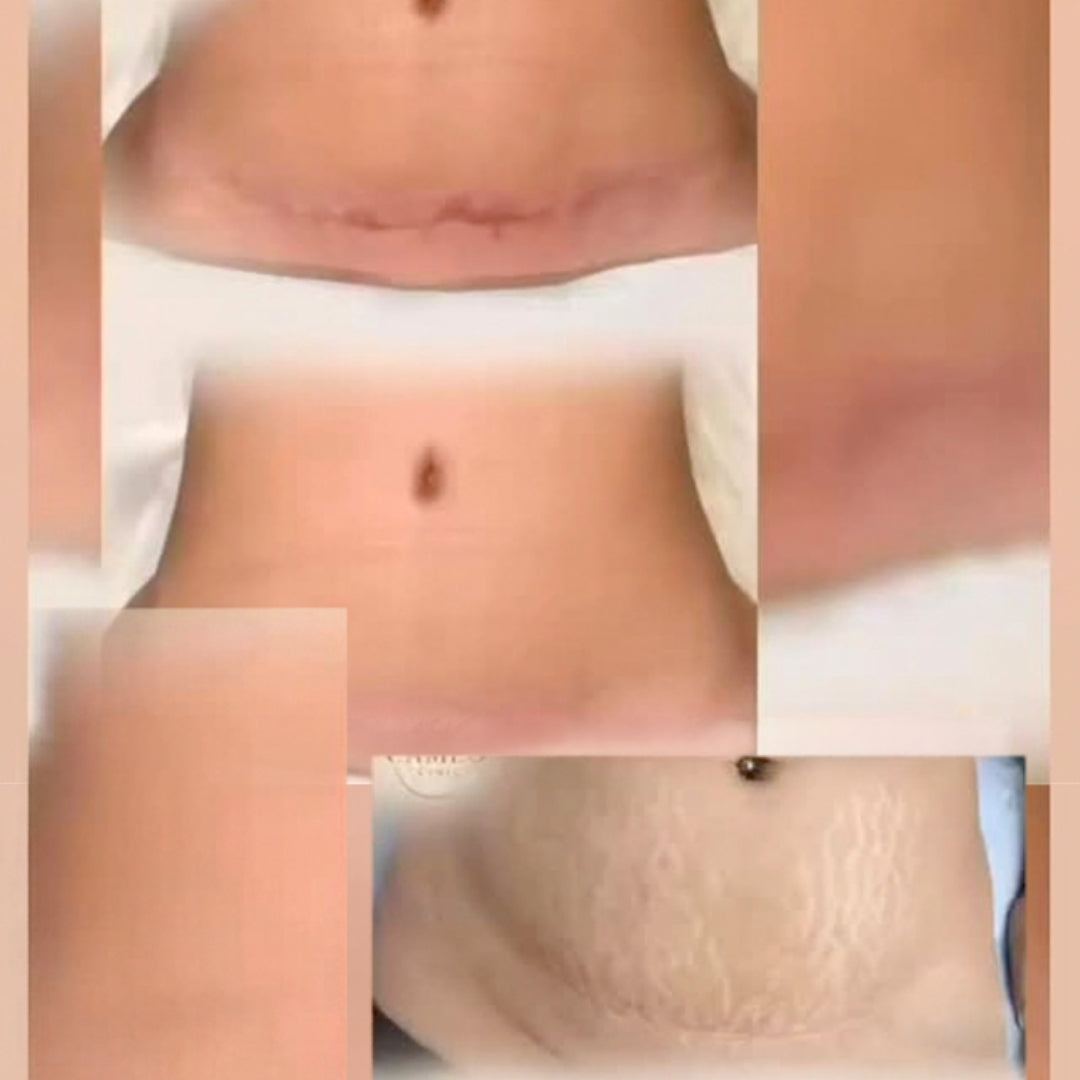 Cameo Clinic - Stretch Mark & Scar Treatment