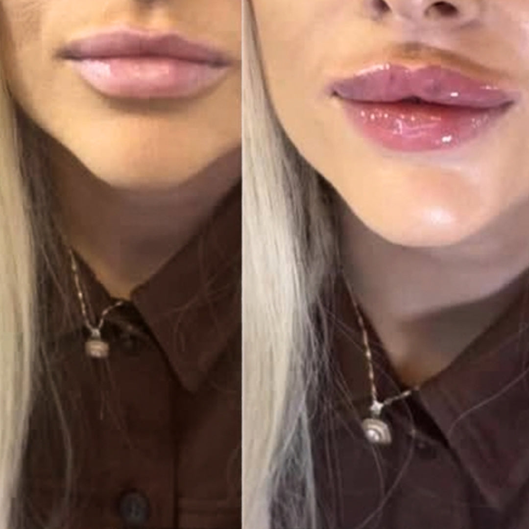Cameo Clinic - Dermal Fillers