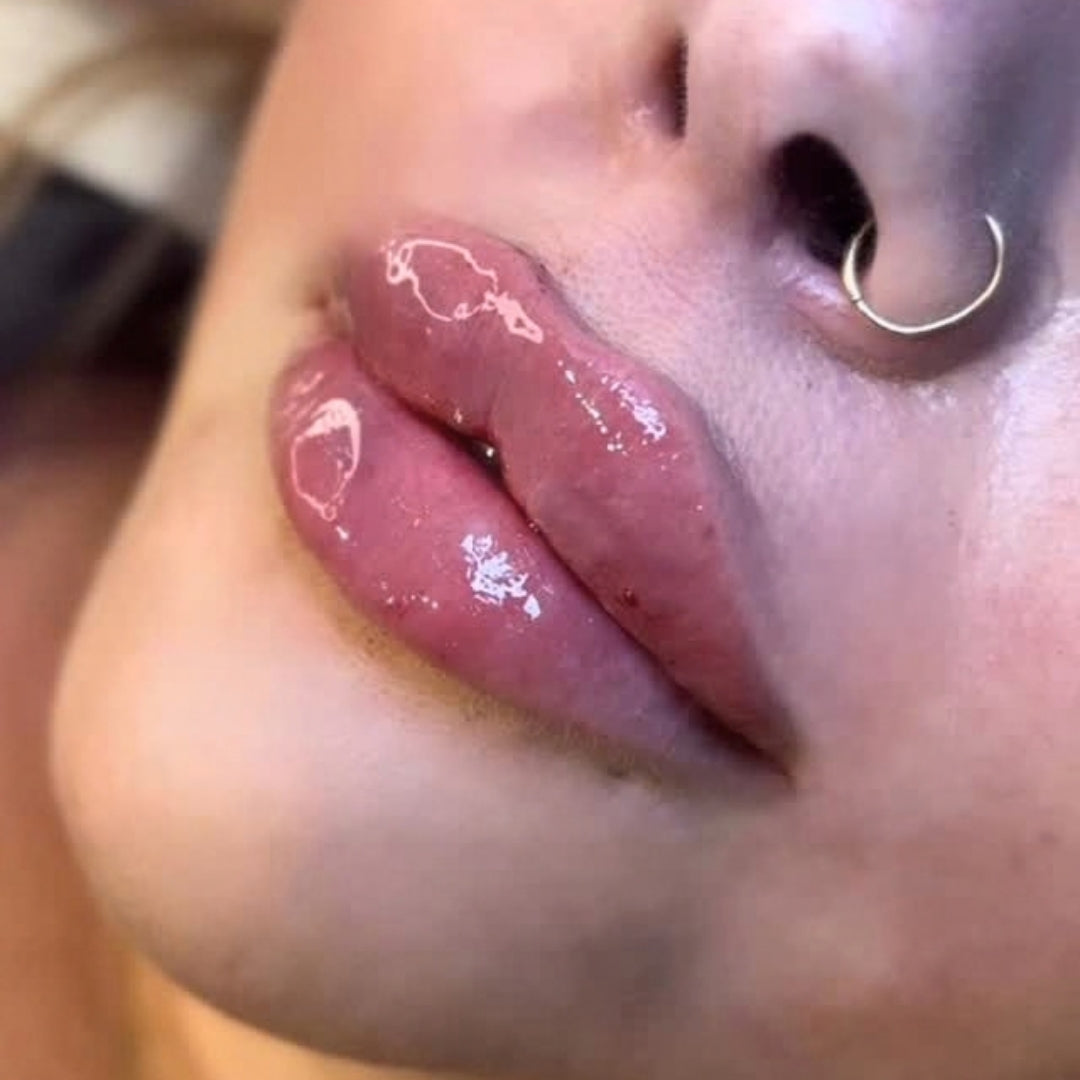 Cameo Clinic - Dermal Fillers